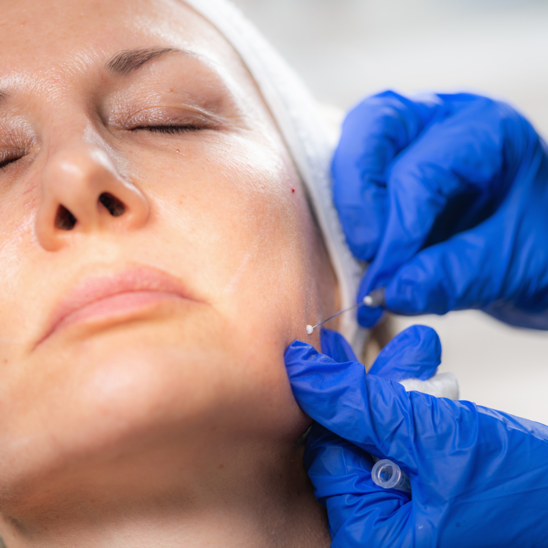 PDO Szálak – EA Beauty Medical