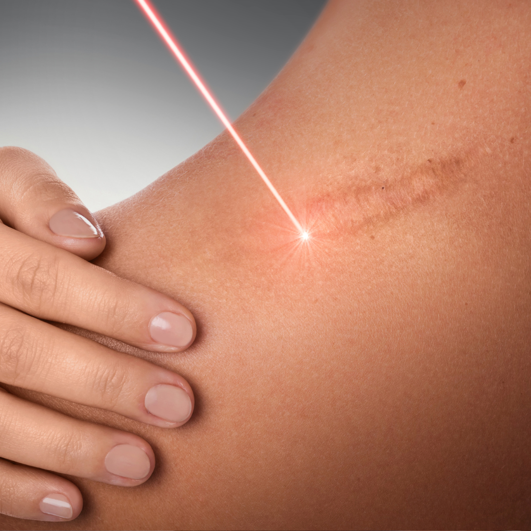 CO2 fractional laser hegkezelés