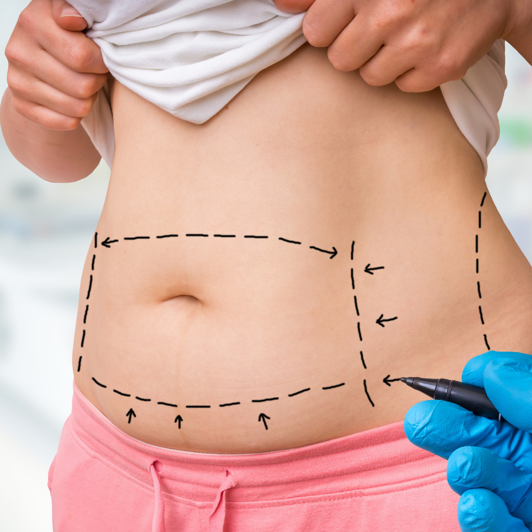 Zsírleszívás – tájékoztató kép – EA Beauty Medical