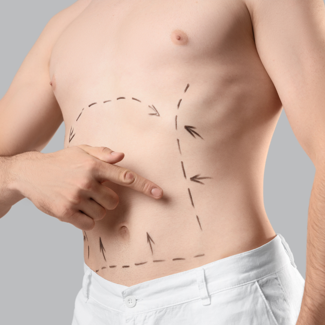 Felsőtestplasztika – tájékoztató kép – EA Beauty Medical