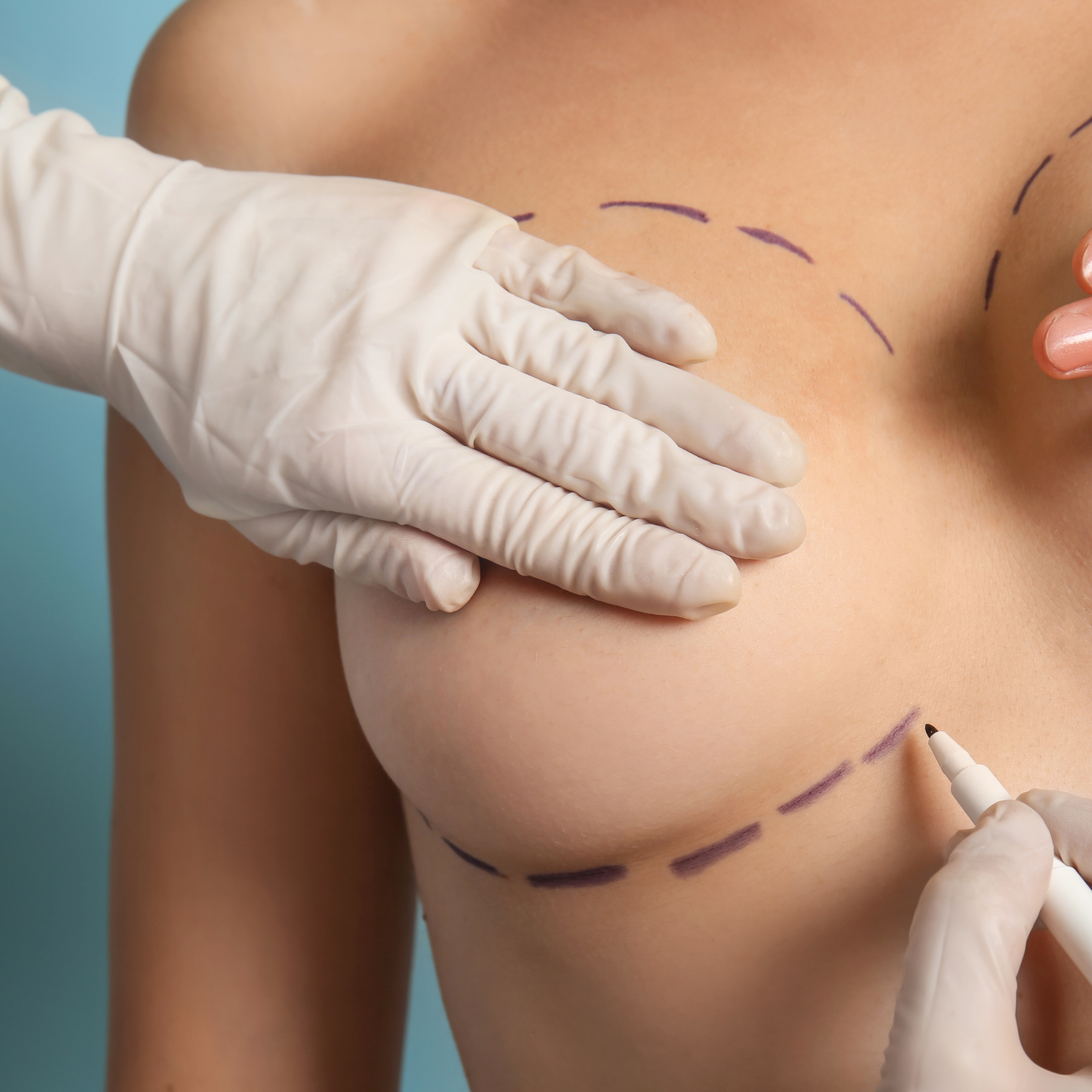 Mellkisebbítés (redukciós mammoplasztika)