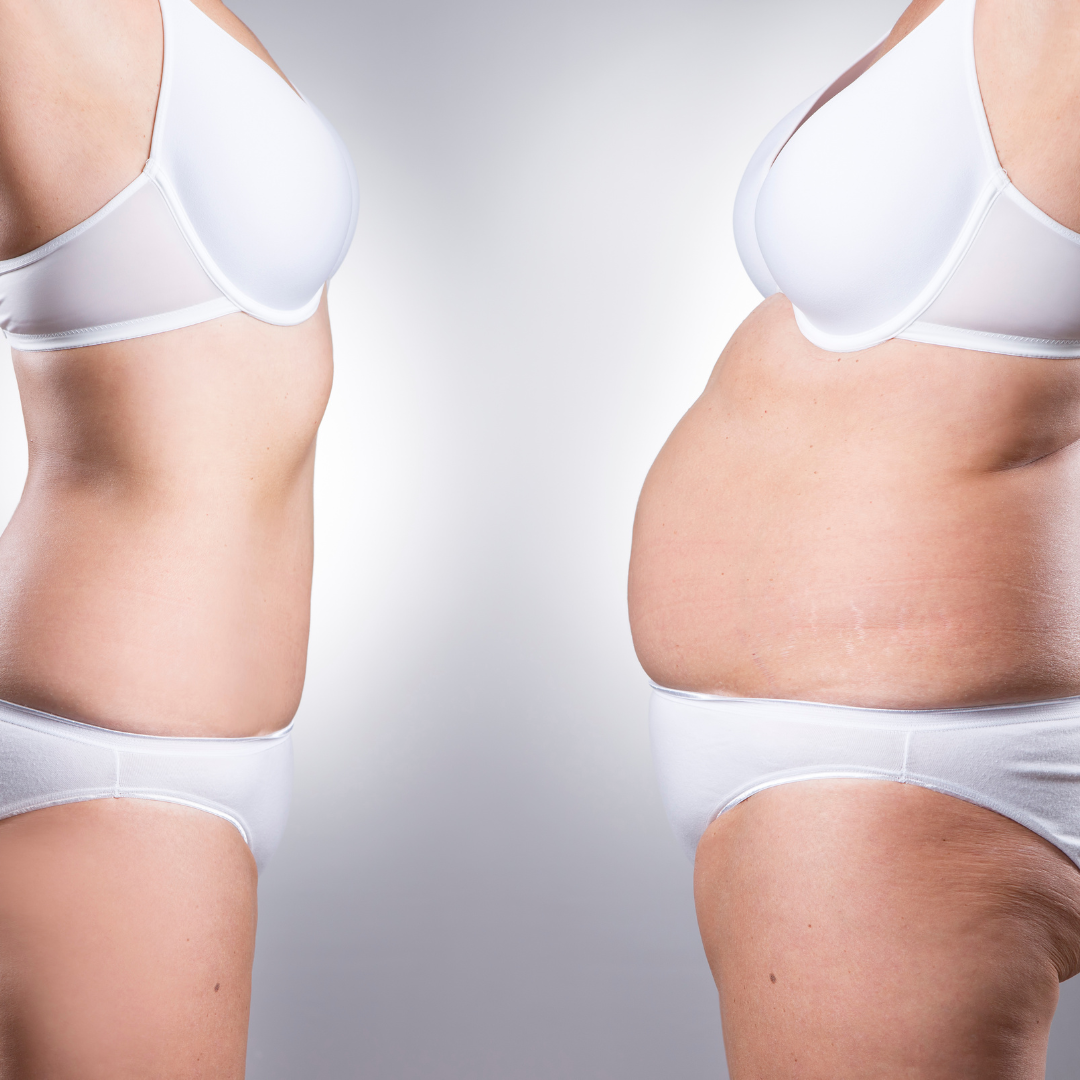 Gyomorszűkítő műtét (bariátriai műtét)