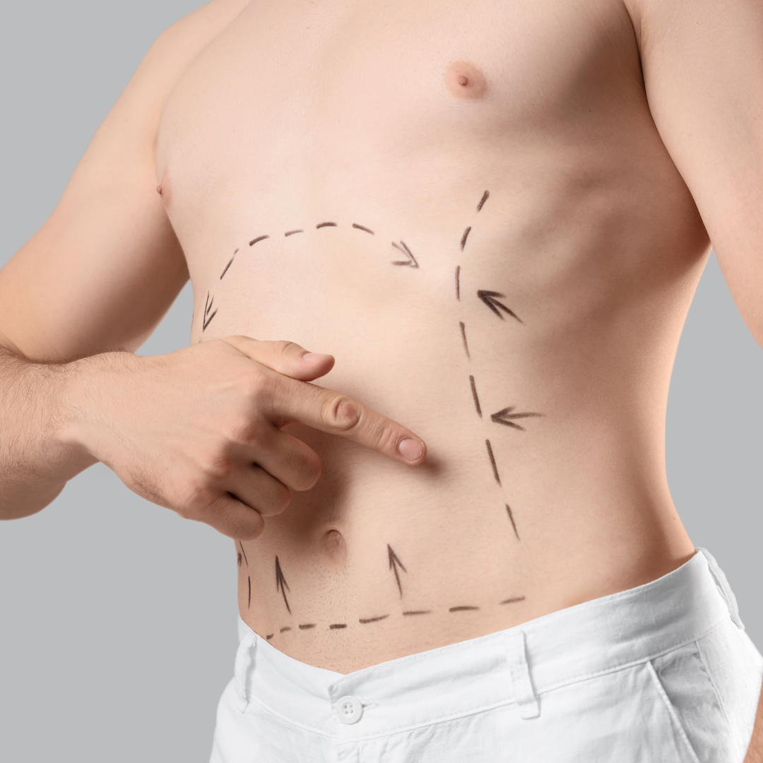 Hasplasztika (abdominoplasztika)