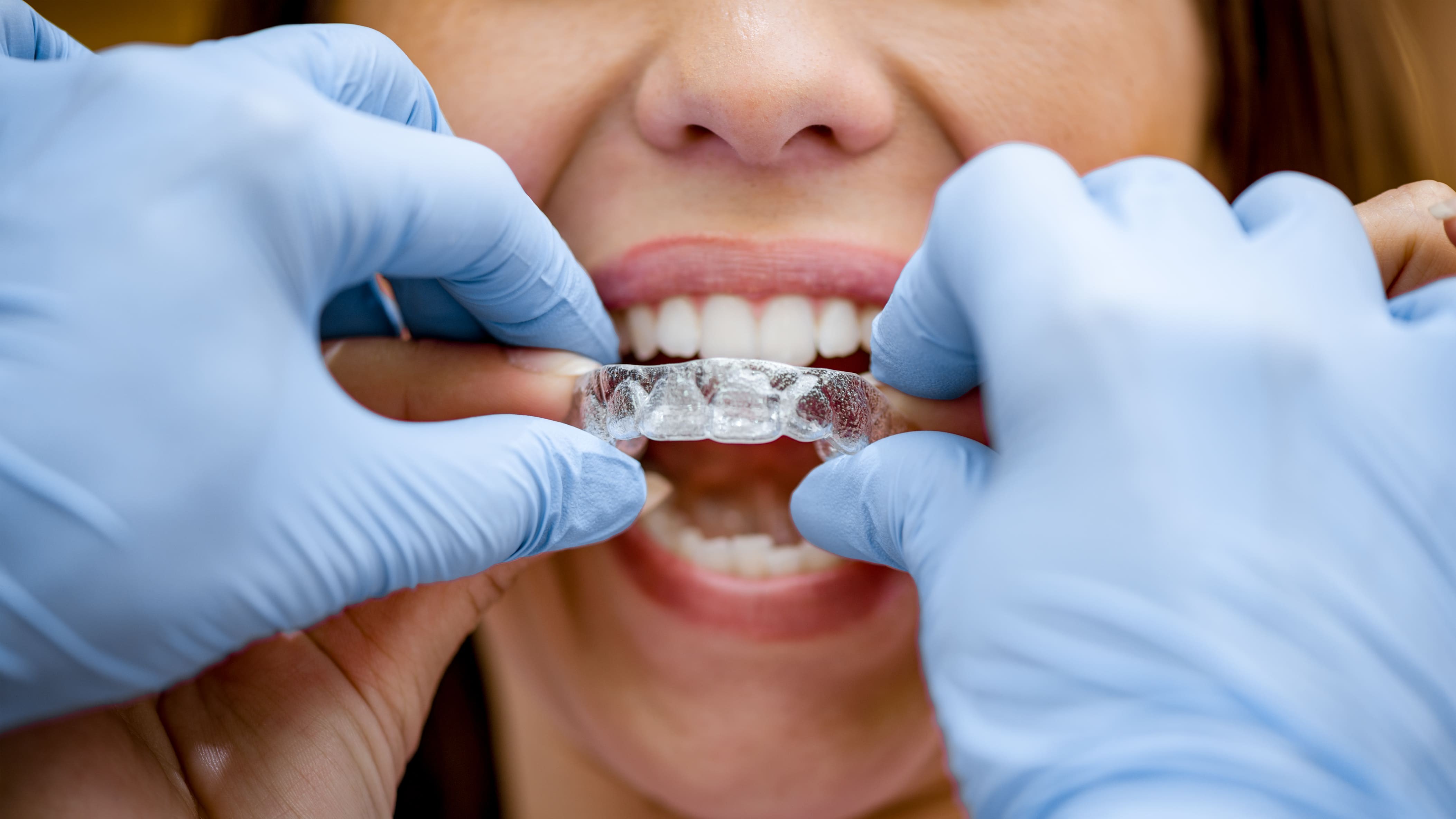 Alineadores transparentes