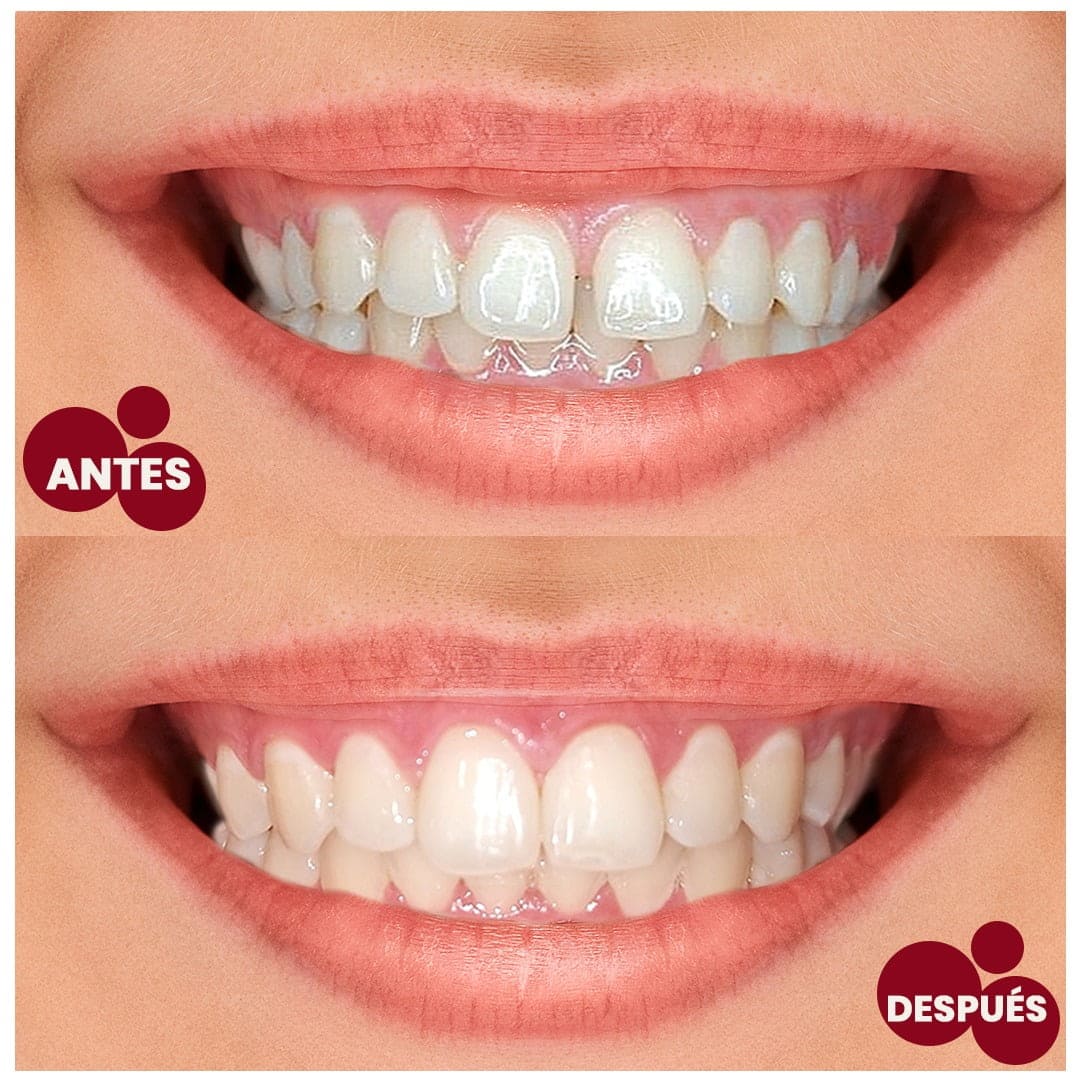 Antes y después ortodoncia invisible 3