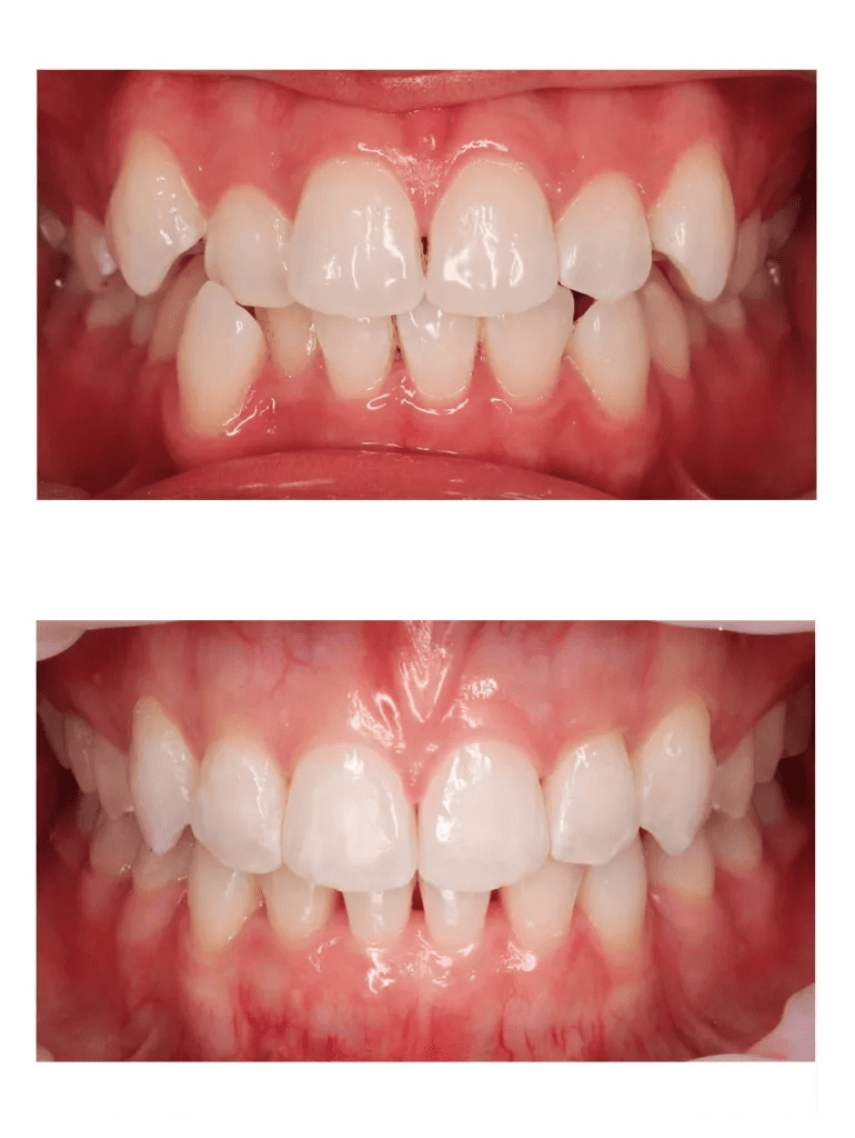 Antes y después ortodoncia invisible 1