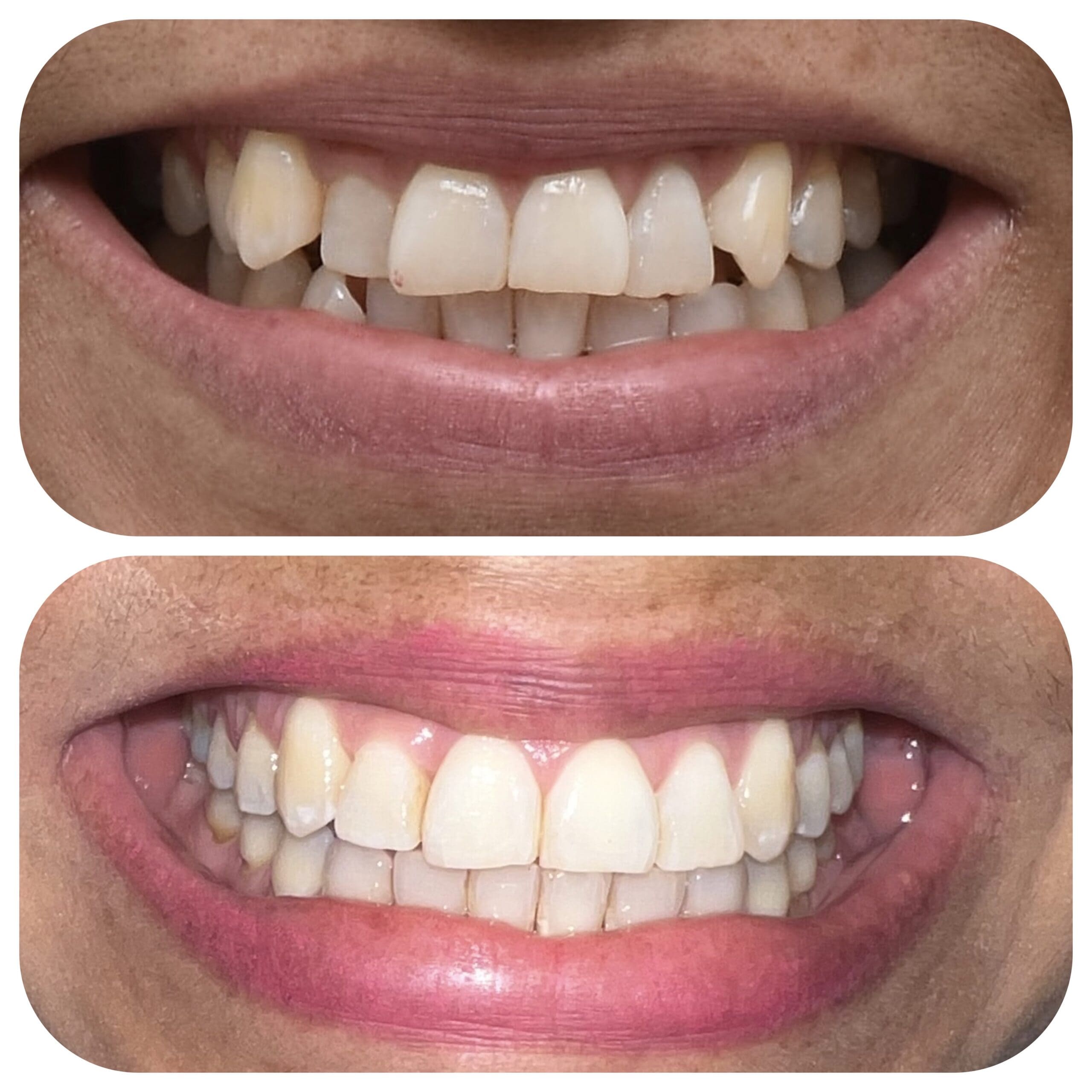 Antes y después ortodoncia invisible 2