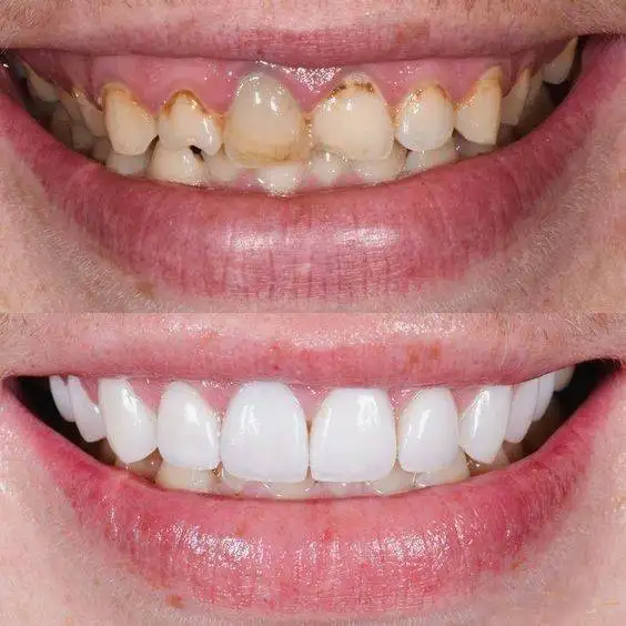 Antes y después carillas 3