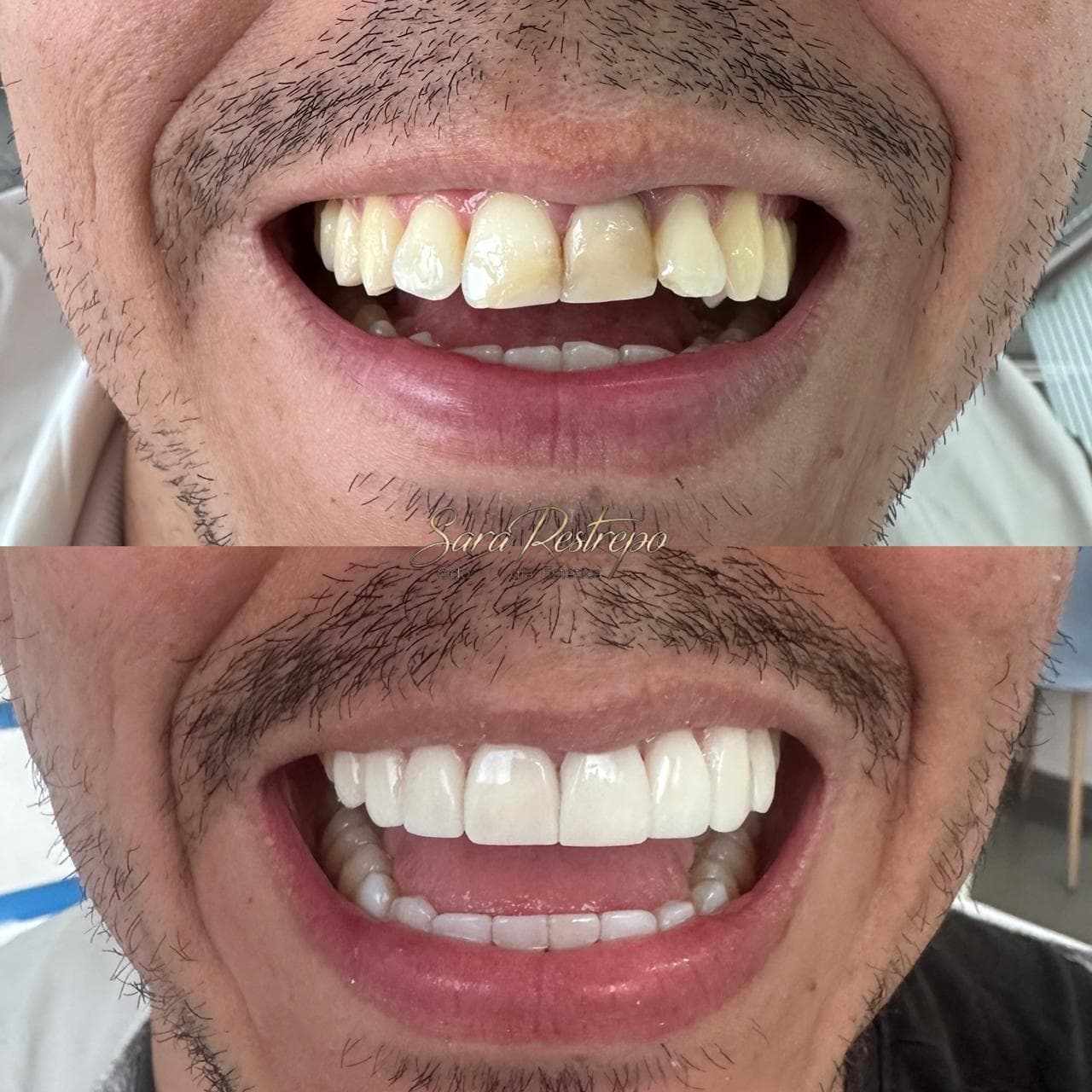 Antes y después carillas 1