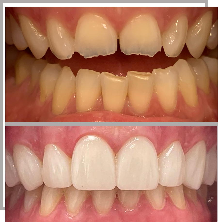 Antes y después carillas 2