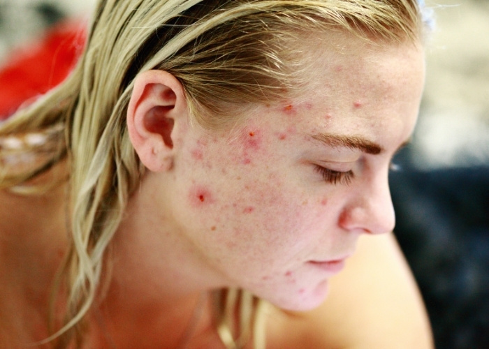 Acne Skin Challenges as a Result of Gut Imbalances