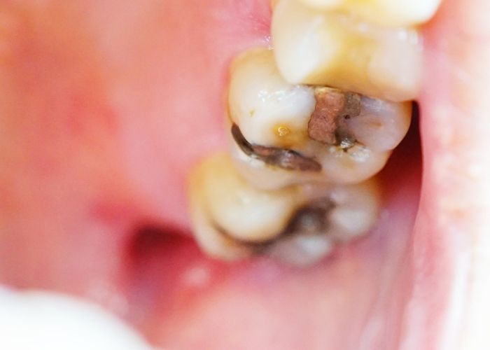 Mercury Fillings and Nervous System Dysregulation