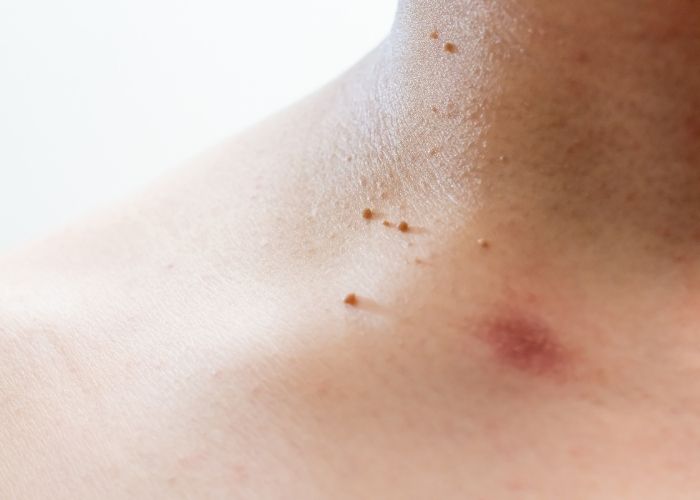 Skin Tags as a Sign of Metabolic Imbalance Skin Tags as a Sign of Metabolic Imbalance
