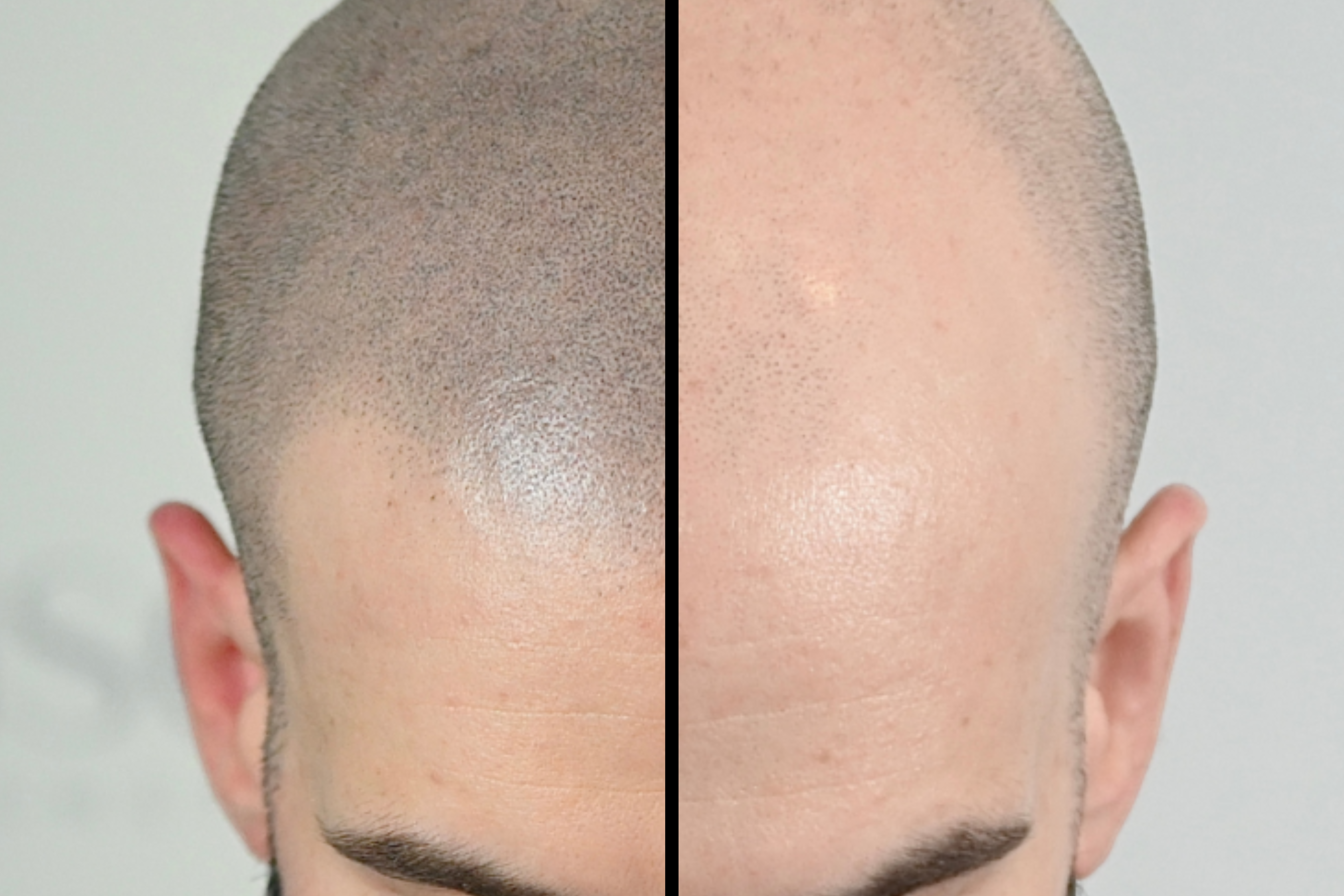 Scalp Micropigmentation
