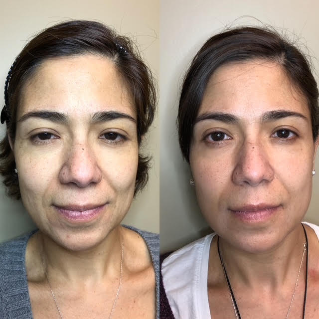 Patient result — natural-looking rejuvenation