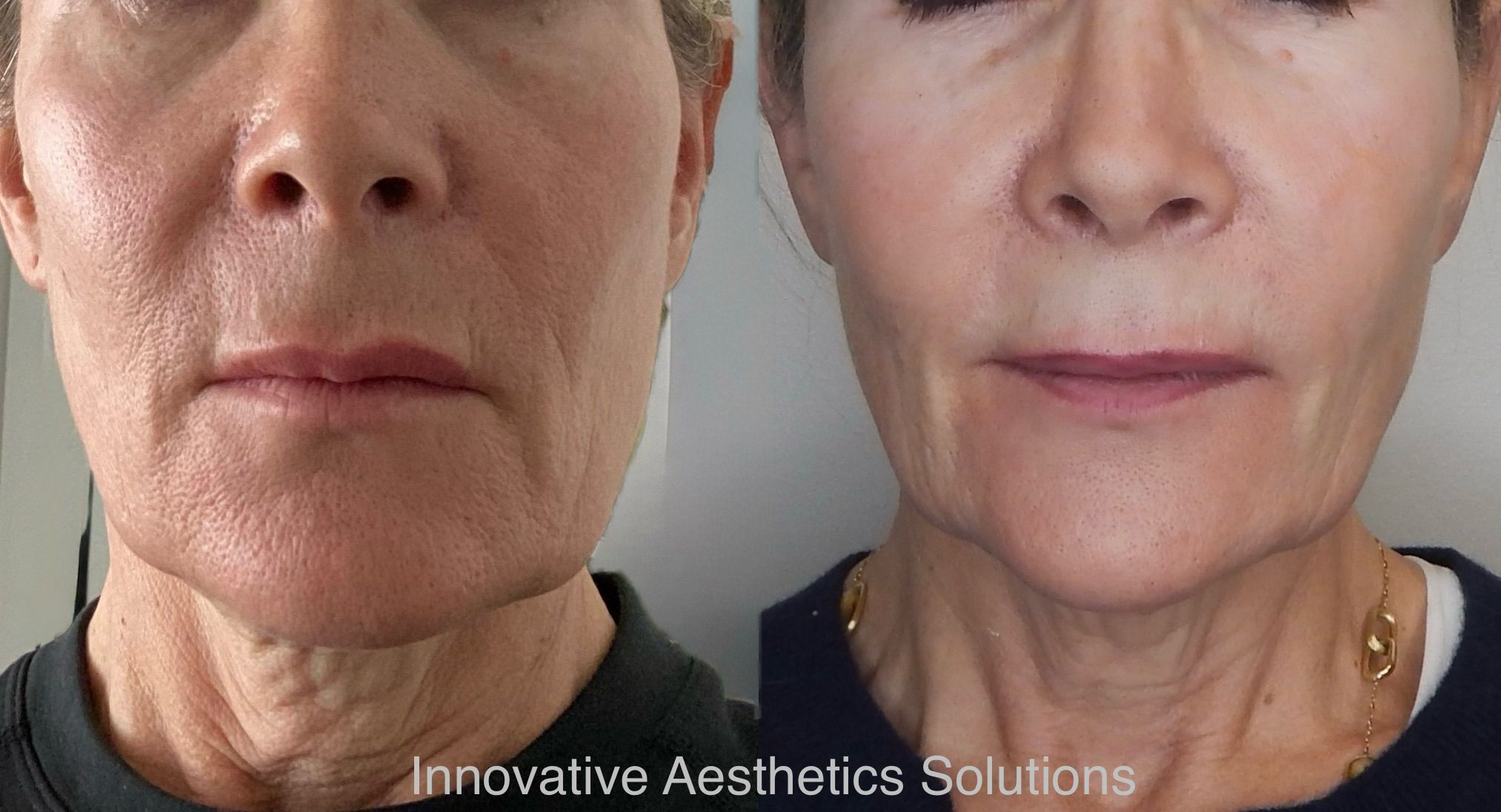 Patient result — improved firmness