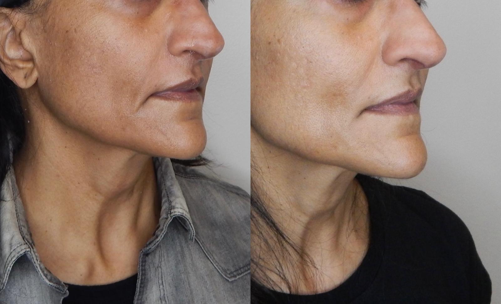 Patient result — improved skin texture