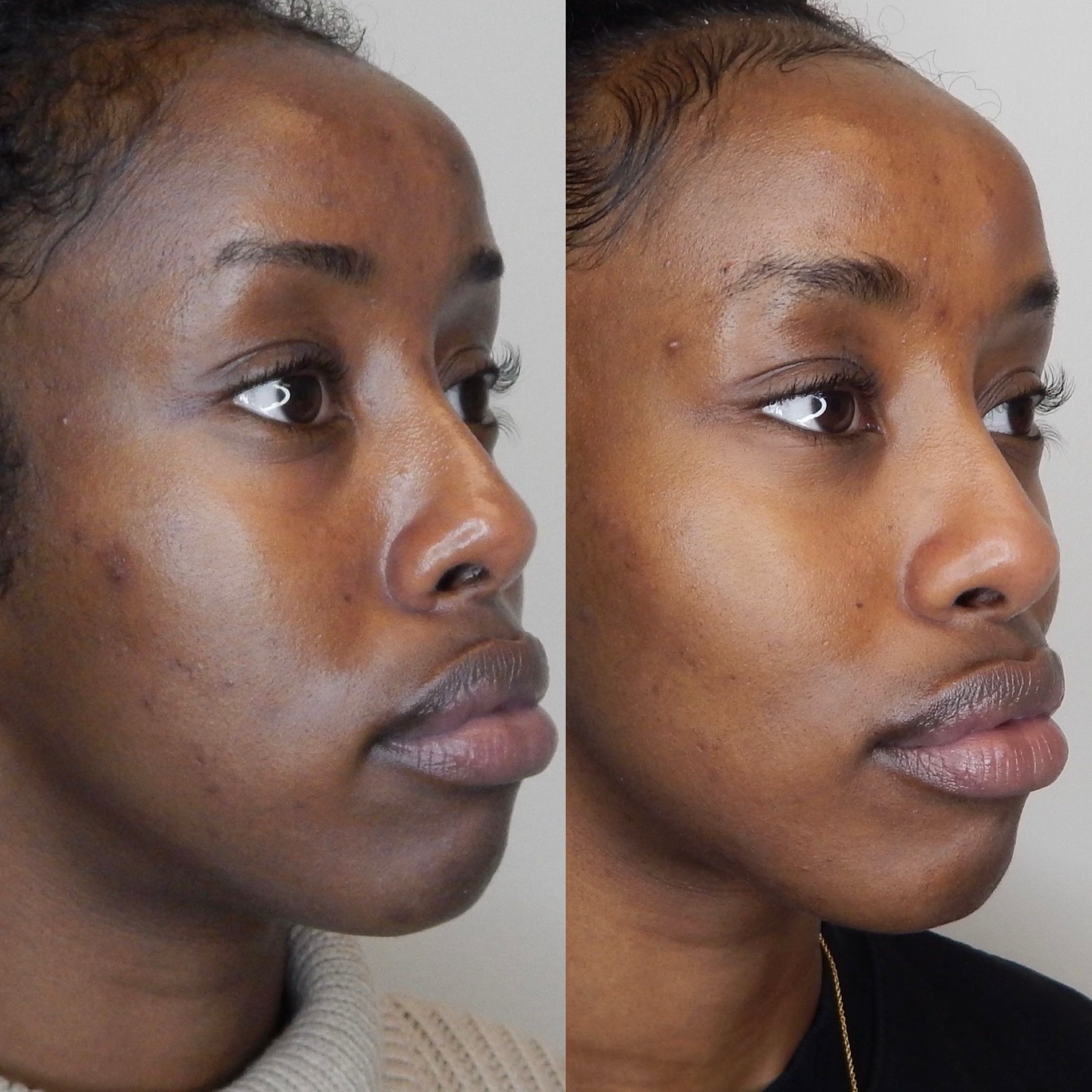 Patient result — improved skin quality