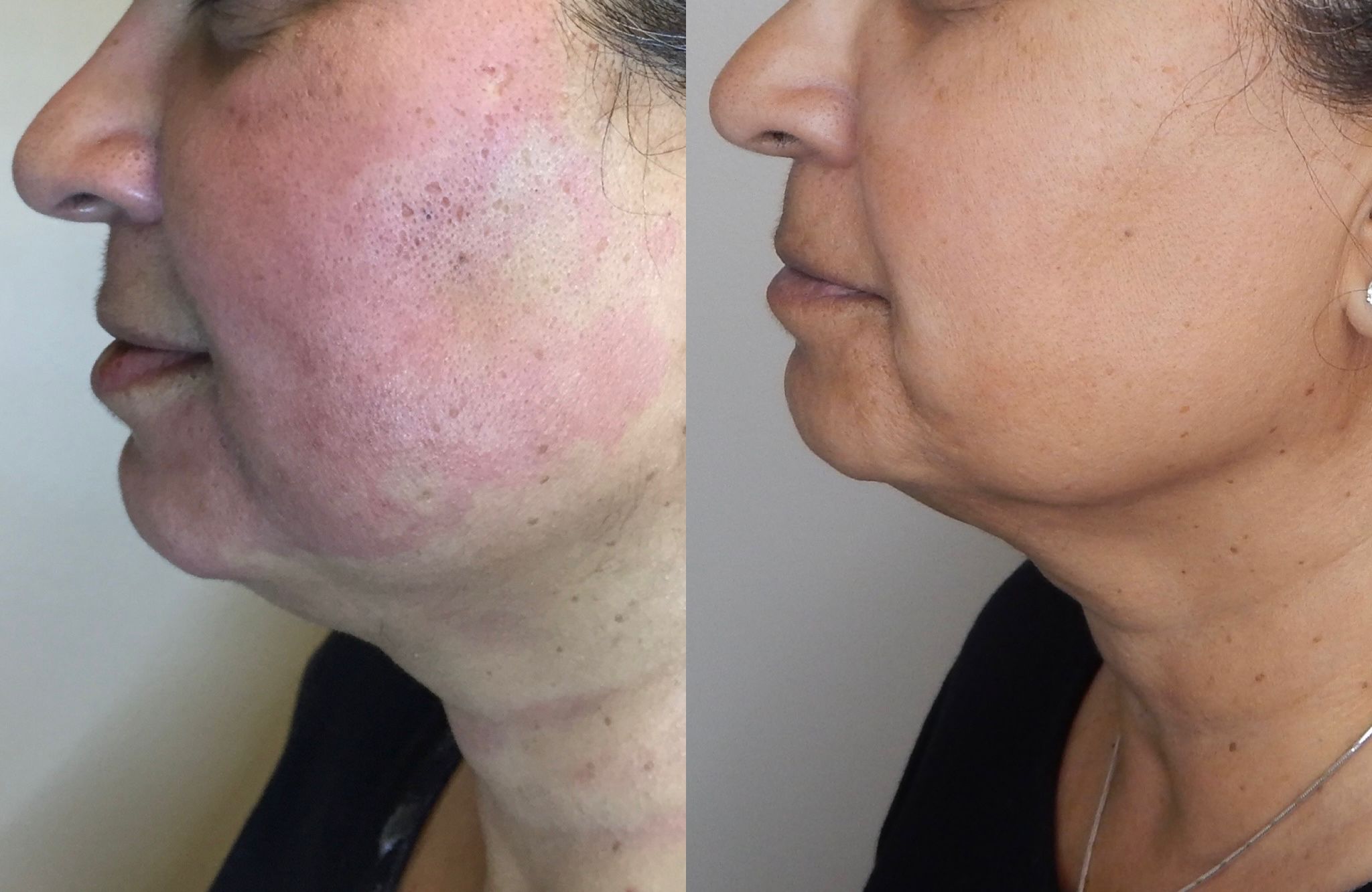 Patient result — refreshed, healthy-looking skin