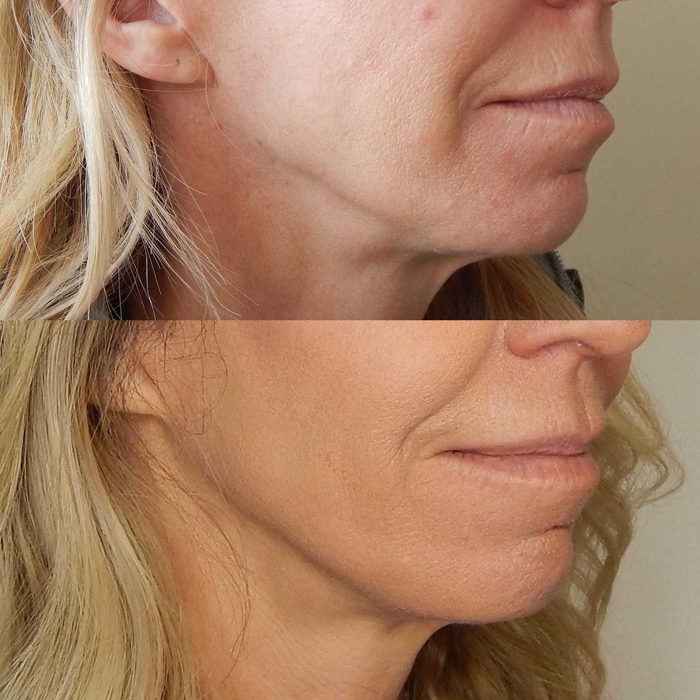 Patient result — skin quality and texture improvement