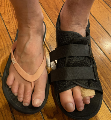 Close up of a pair of feet, one in a cast shoe Close up of a pair of feet, one in a cast shoe
