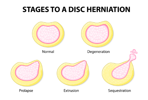 Bulging Disc vs. Herniated Disc: What&rsquo;s the Difference? Can 