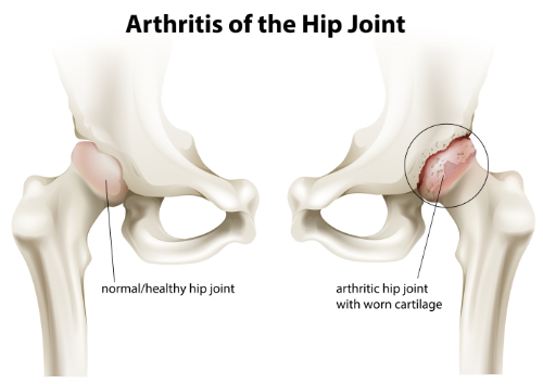 How to Overcome Hip Pain Using Chiropractic