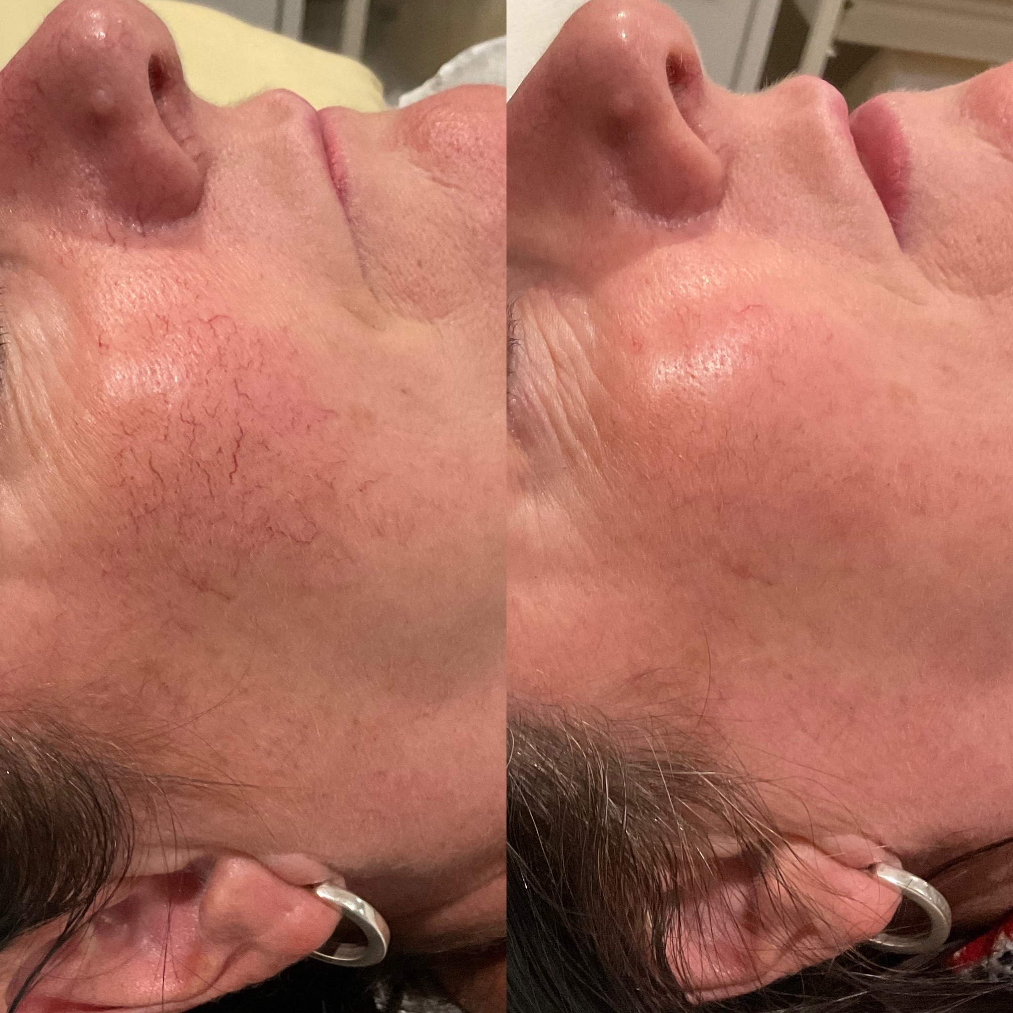Riverbanks patient before and after VBEAM treatment for facial thread veins