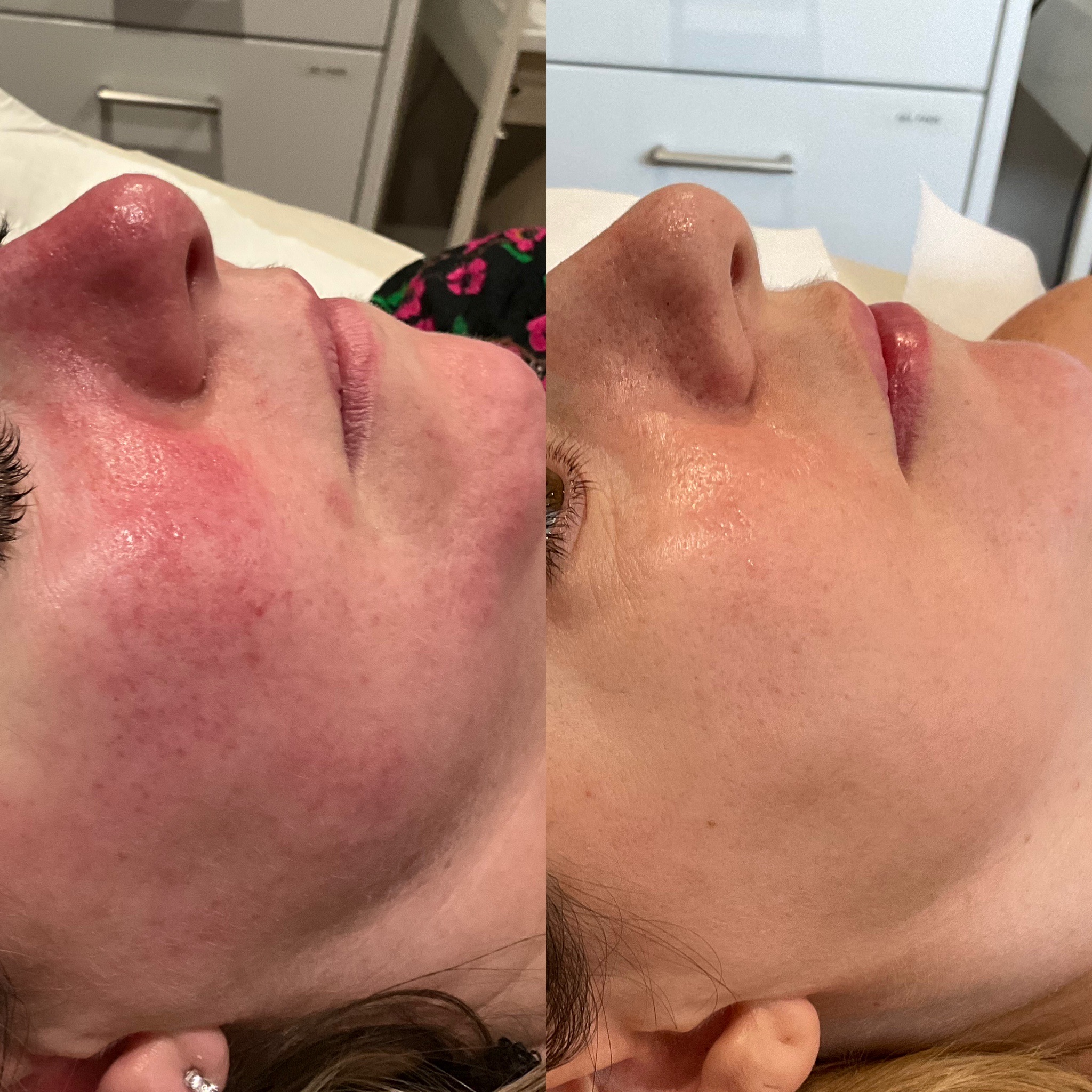 Riverbanks patient before and after VBEAM treatment for diffuse facial redness