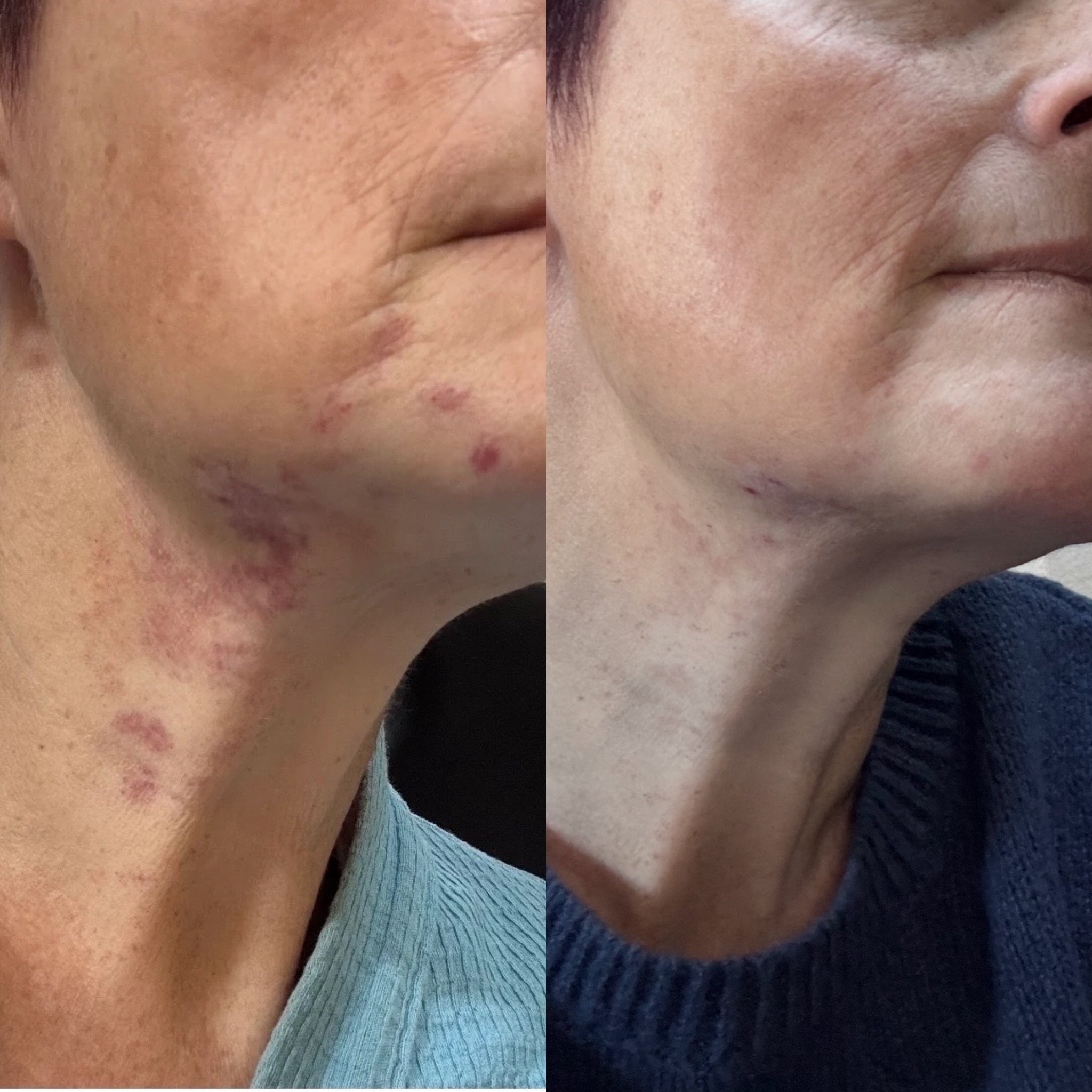 Riverbanks patient before and after VBEAM treatment for a facial port-wine stain