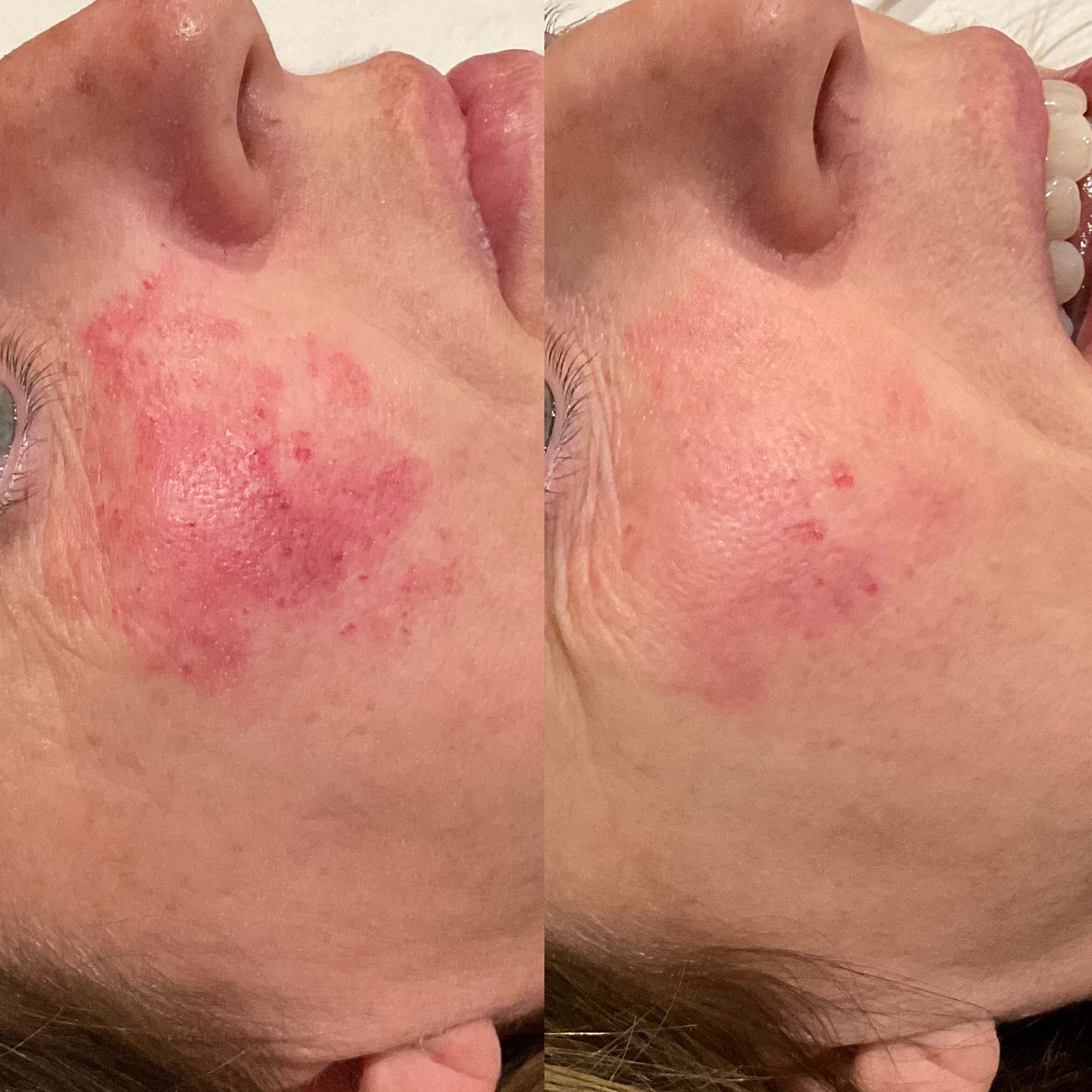 Riverbanks patient before and after VBEAM treatment for rosacea and facial redness