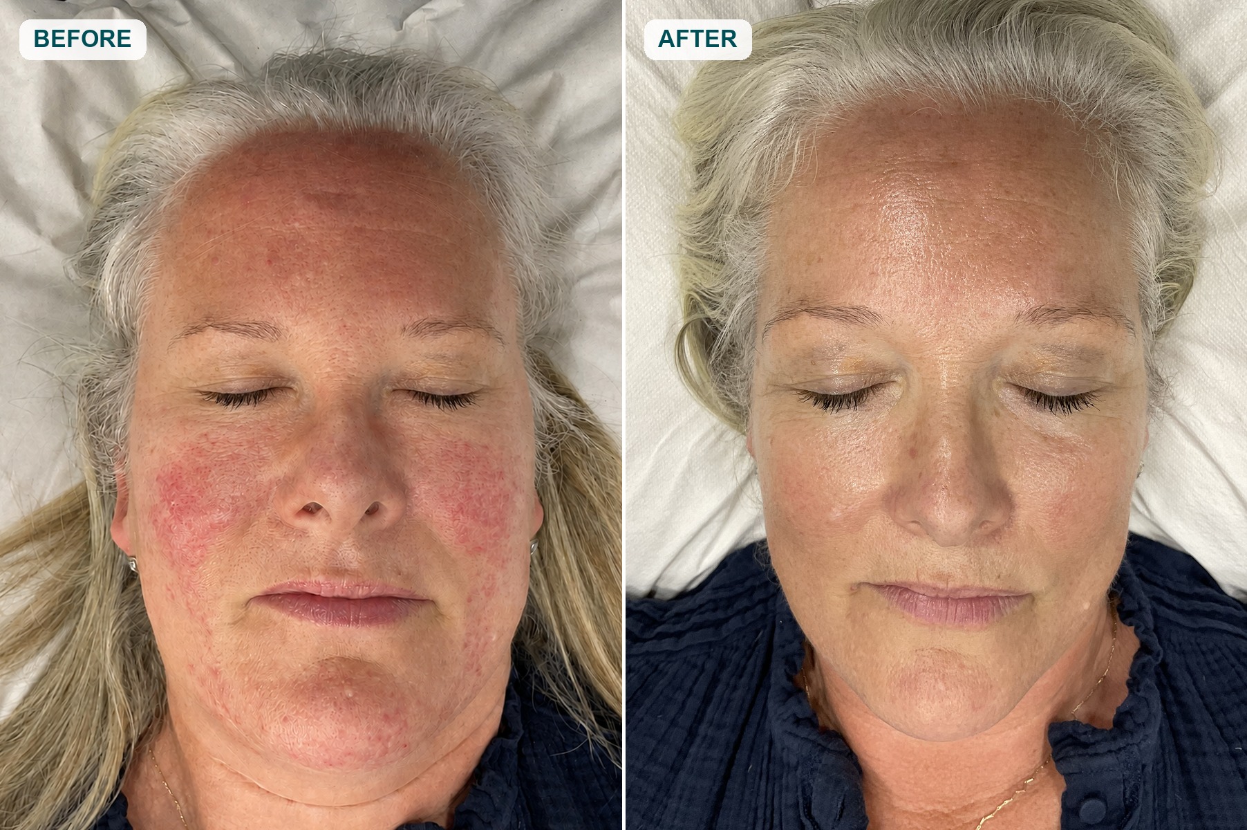 Riverbanks patient before and after three VBEAM treatments for rosacea