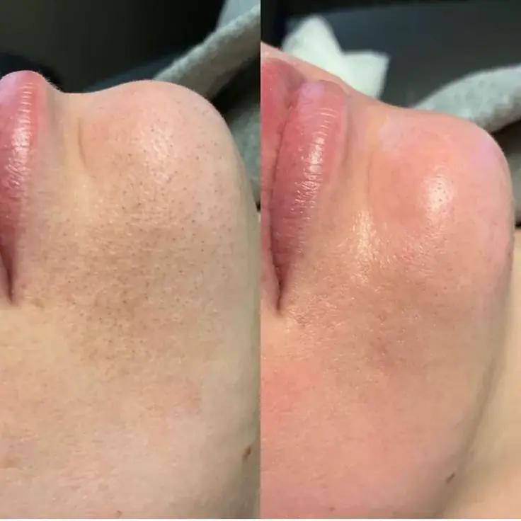 Peau nette après laser