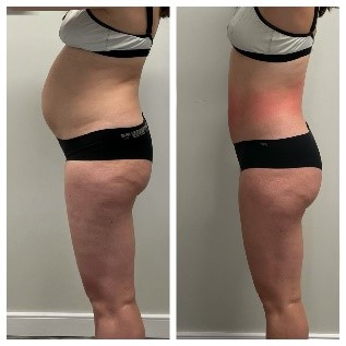 Before After 2