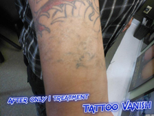 Tattoo Removal