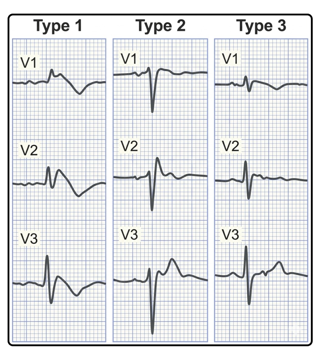 ECG comparison of Brugada syndrome Type 1, Type 2, and Type 3 patterns in leads V1–V3.