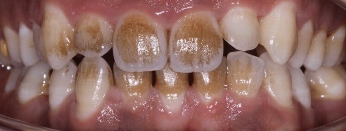 Integrity Dental Boston patient before treatment, worn discolored teeth, front-facing close-up