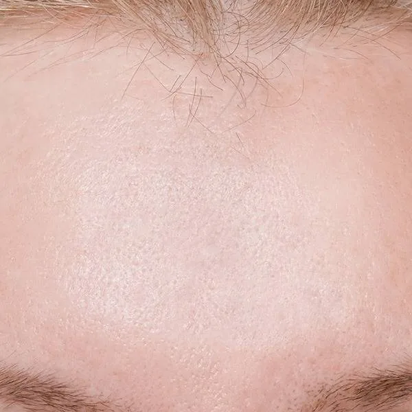 Smooth forehead after a wrinkle relaxer treatment