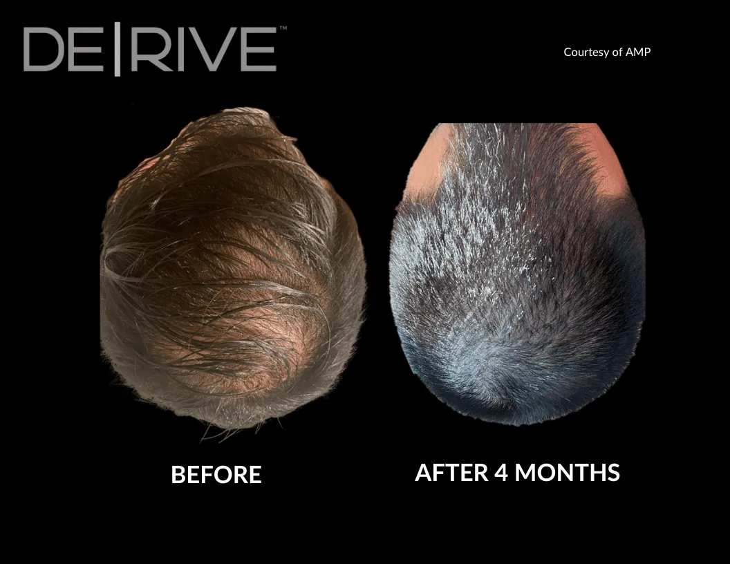 De|Rive before and after four months