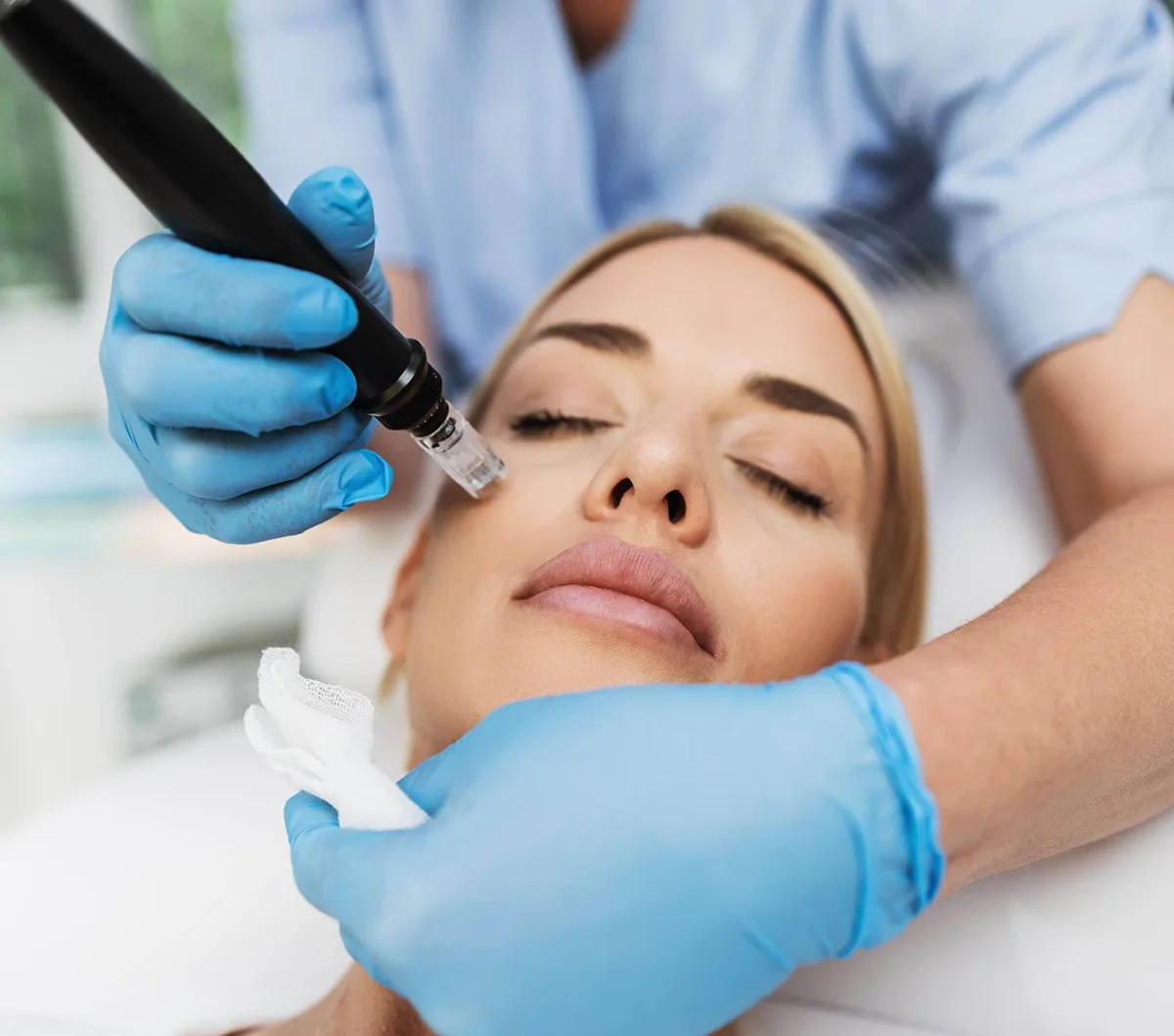 Microneedling with PRP