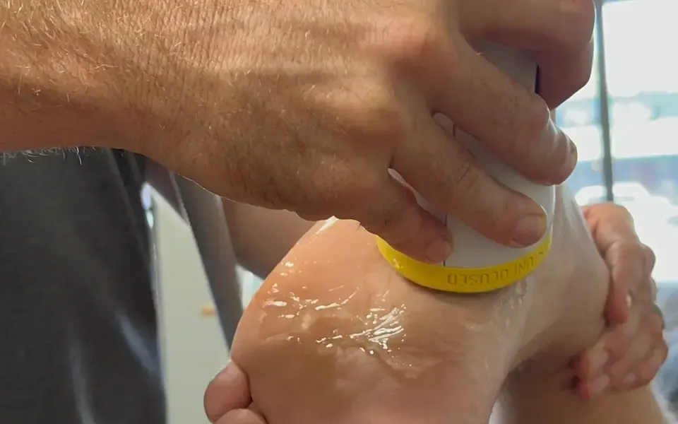 SoftWave treating plantar fasciitis