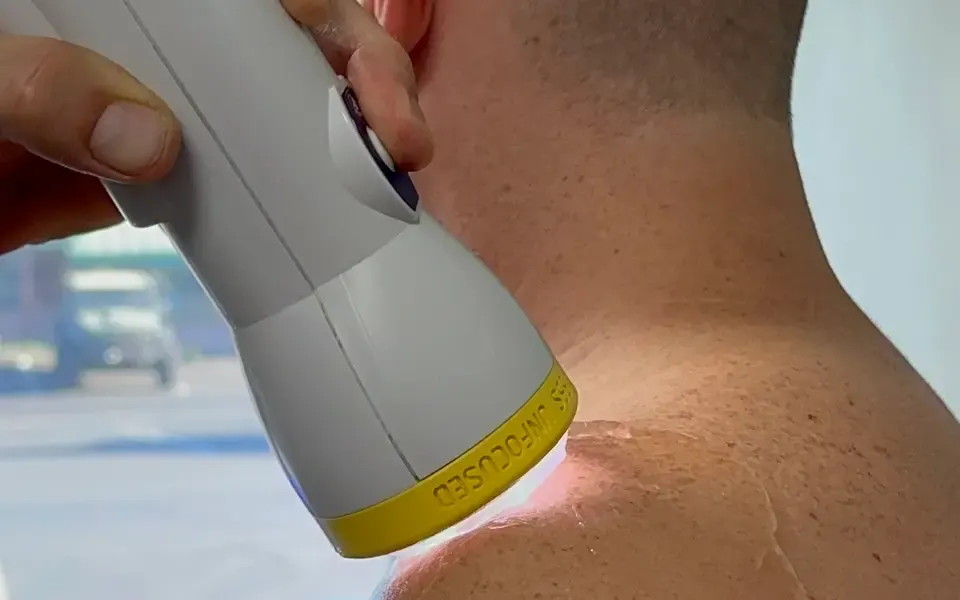 SoftWave treating the back of the neck