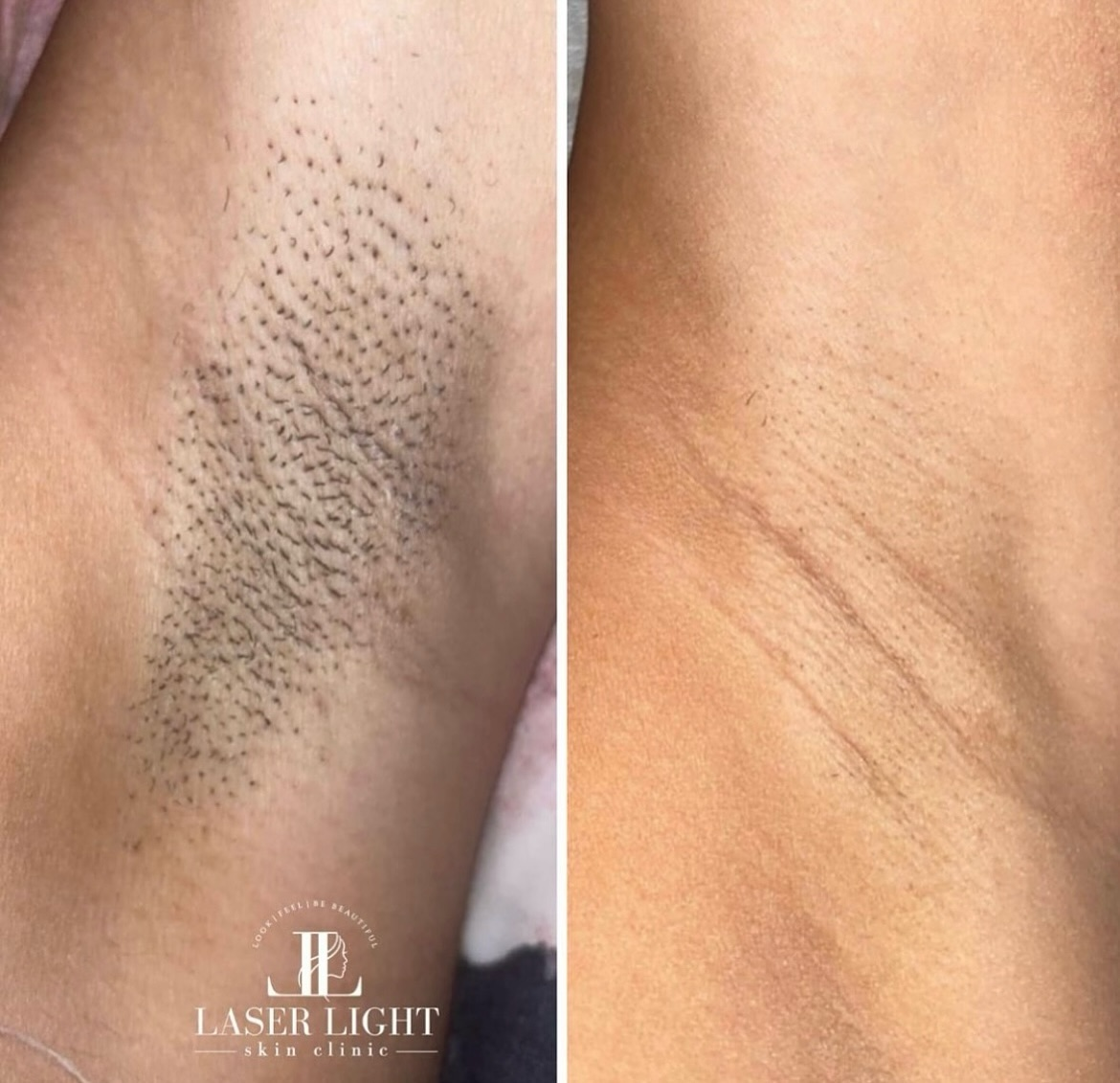 Laser Hair Removal Result 1