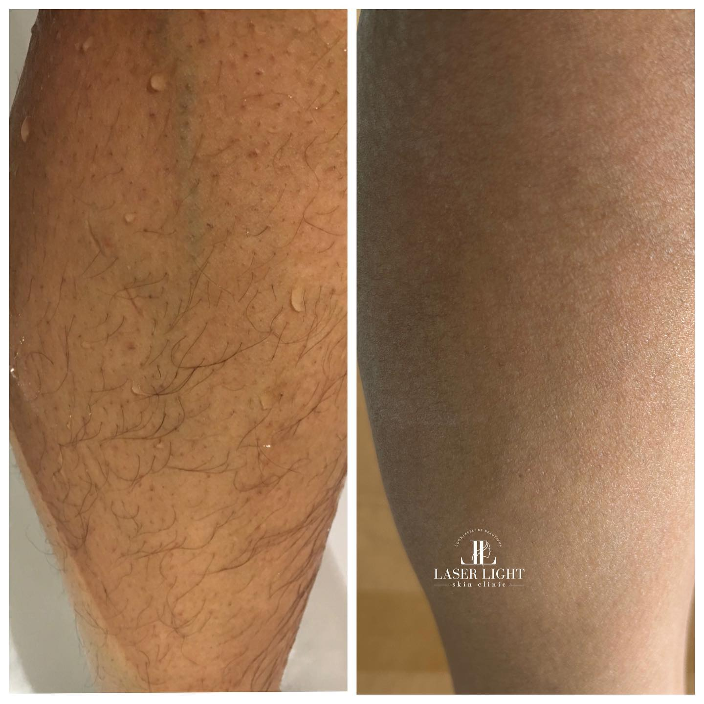 Laser Hair Removal Result 2