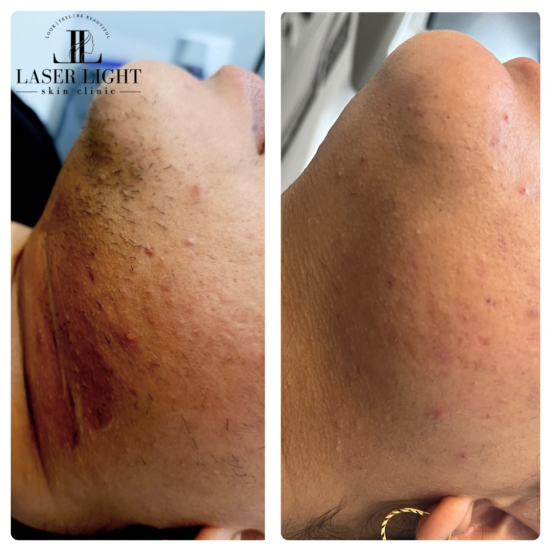 Laser Hair Removal Result 3