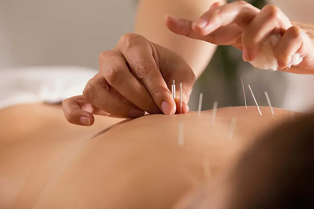 Acupuncture Needles 