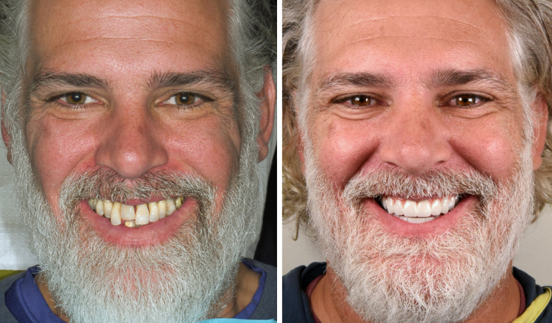 Full Mouth All on 4 Teeth in a Day Photo