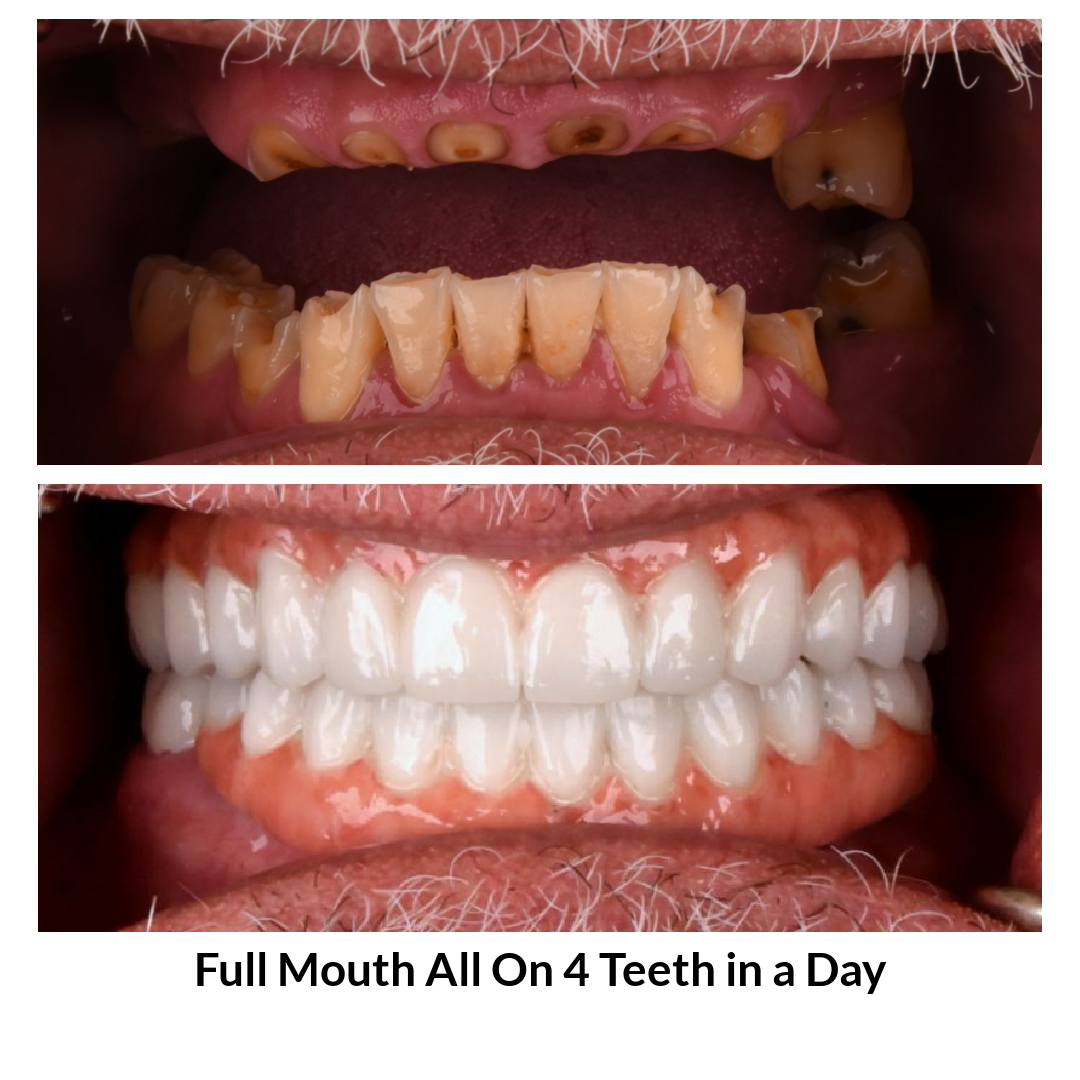 Full Mouth All on 4 Teeth in a Day Photo