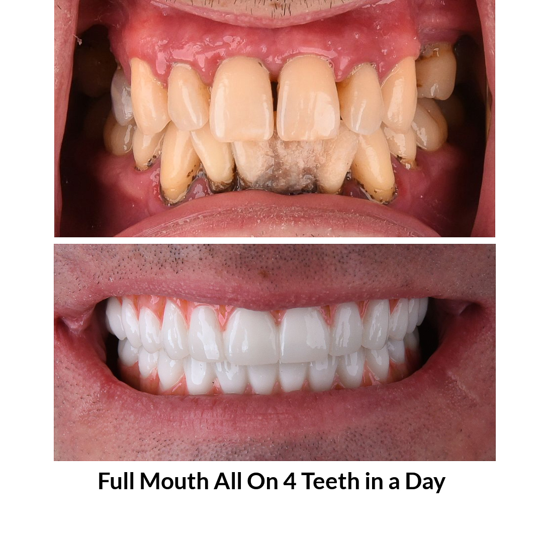 Full Mouth All on 4 Teeth in a Day Photo