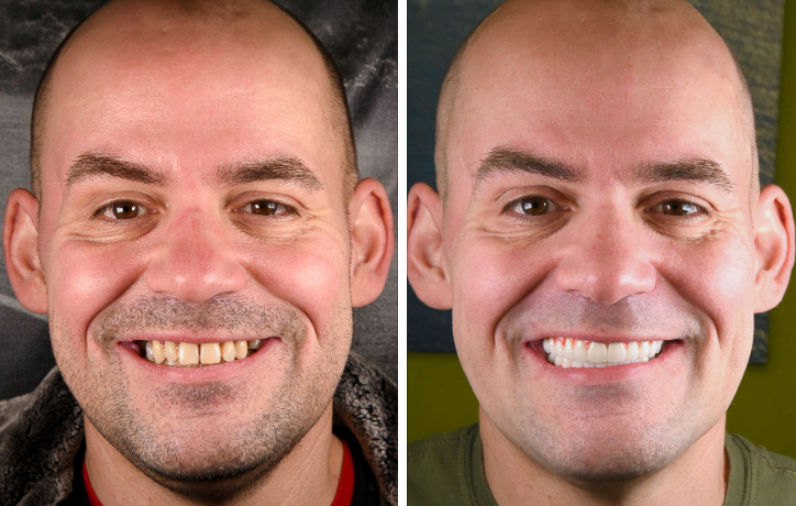 Full Mouth All on 4 Teeth in a Day Photo